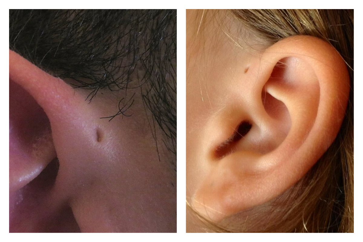 ▲耳朵上有神秘小孔？學者曝「驚人理論」。（圖／翻攝自外媒）