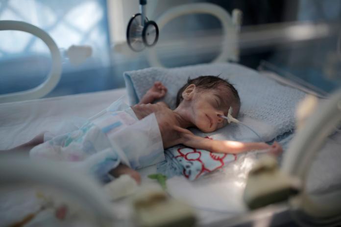 葉門爆發人權危機　新生男嬰營養不良宛如骷髏
