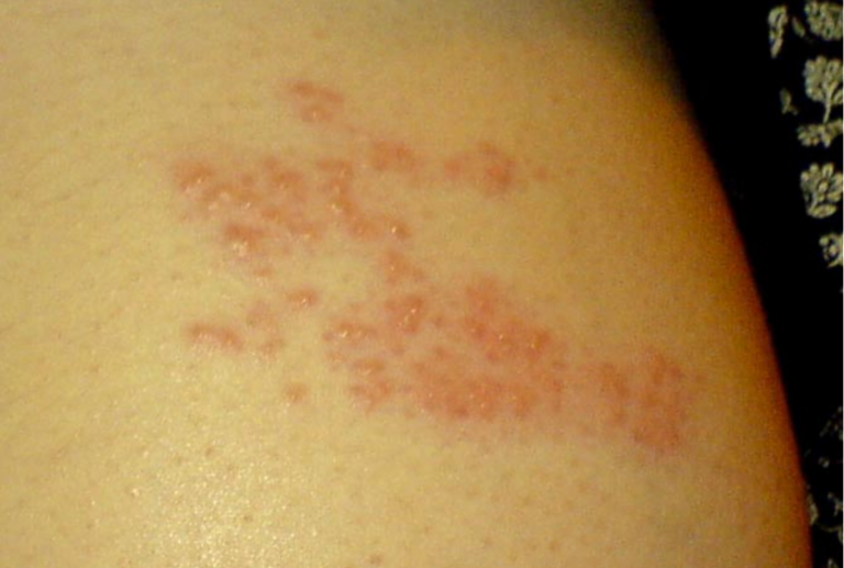 免疫力低時就容易得帶狀皰疹。（圖／WIKI圖庫，Mariegriffiths攝）