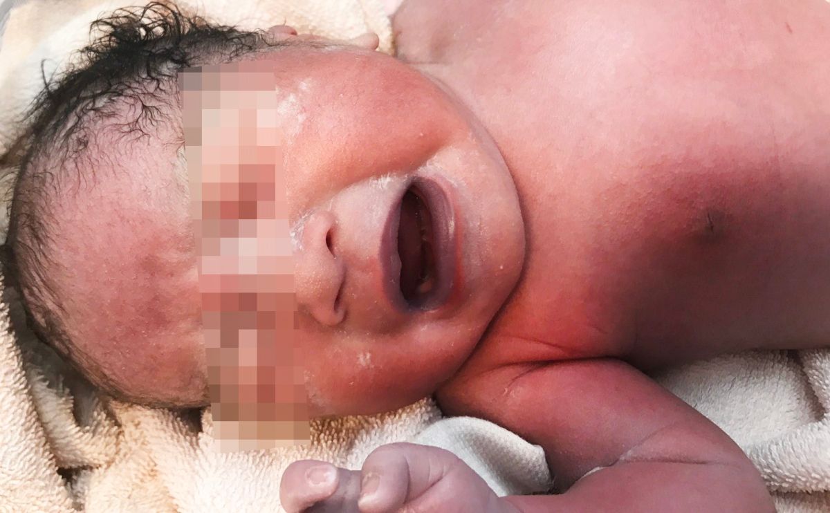 ▲男嬰因心臟破洞，出現唇色發黑、皮膚發藍，命懸一線；幸好及早發現搶救得宜。（圖／東元醫院提供）