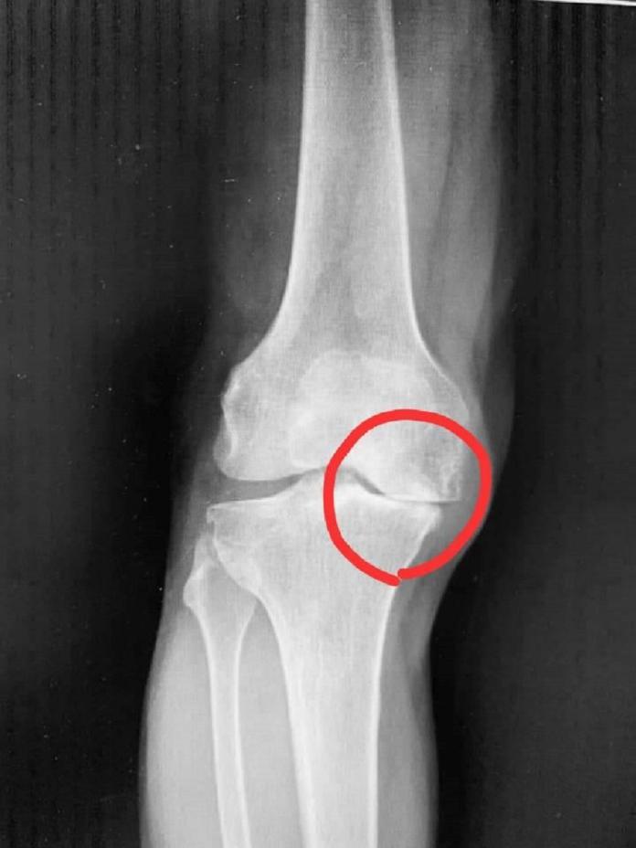 術後狀況良好，展開新「膝」望。〔圖／聖馬爾定醫院提供2019.12.19〕