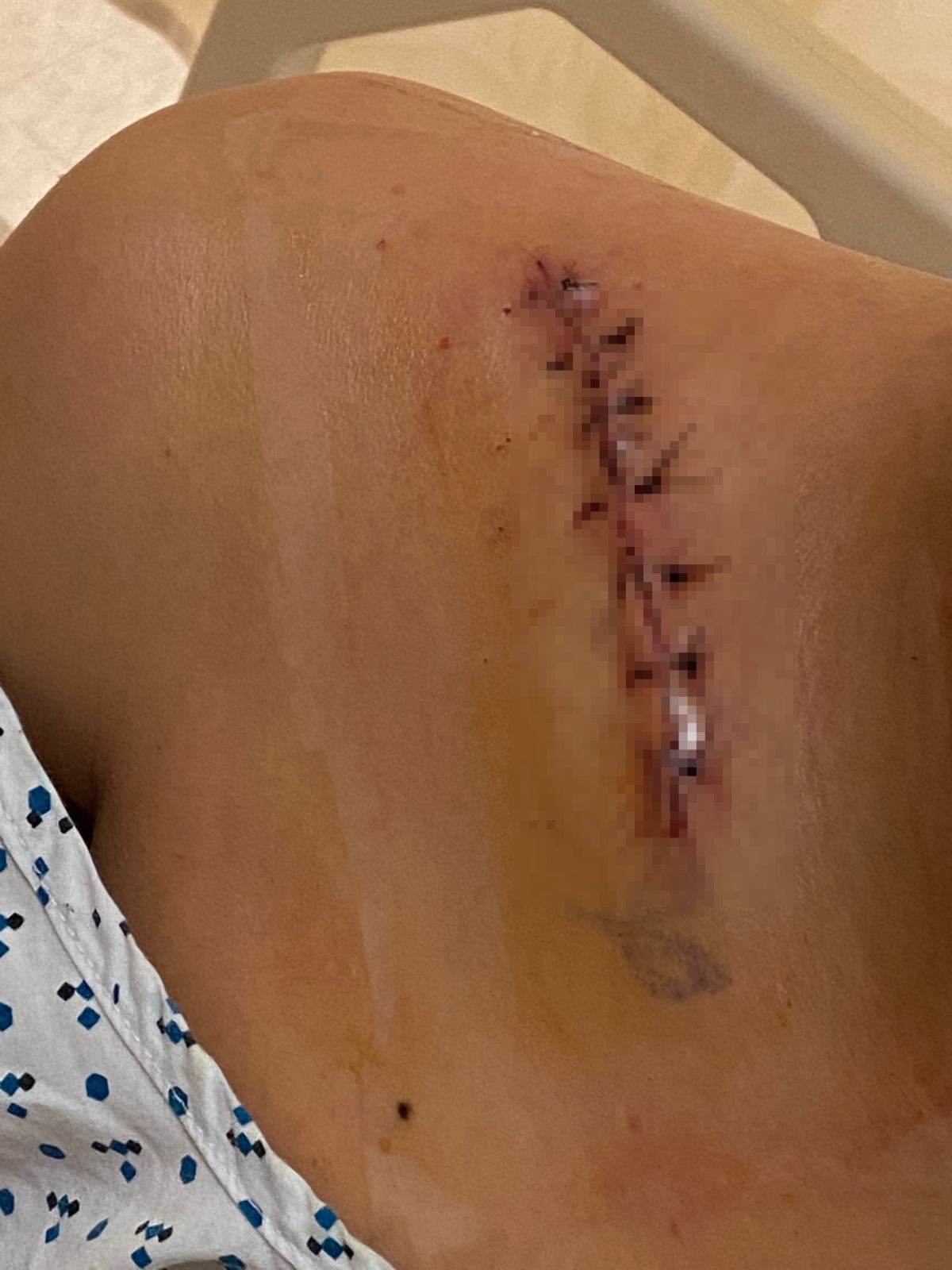 ▲新北市立新埔國小籃球隊在12月20日，到台北市博愛國小參加富鴻盃少年籃球邀請賽，比賽中一位小六的林姓選手不慎跌倒摔傷，又遭他校選手踩踏鎖骨，不幸造成鎖骨斷裂。（圖/劉美芳辦公室提供）