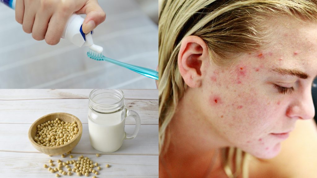 ▲生活習慣也會致痘。（圖／pixabay）