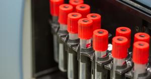 驗阿茲海默風險　美國臨床實驗公司推血液檢查
