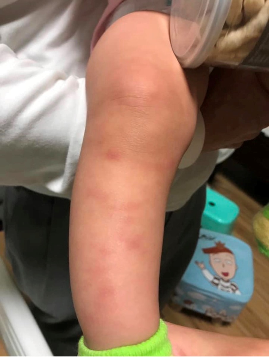 ▲男嬰腿部多處瘀傷。（圖／記者陳聖璋翻攝）