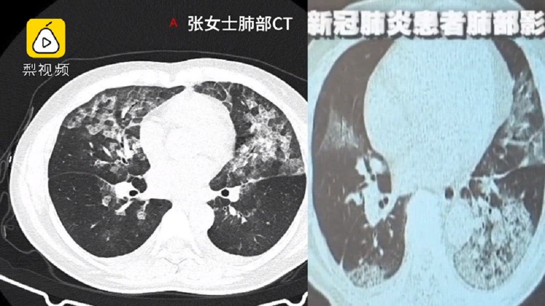 ▲中國大陸2名女子不適就醫，其檢查影像竟與新冠肺炎病患高度相似。（圖／翻攝梨視頻）