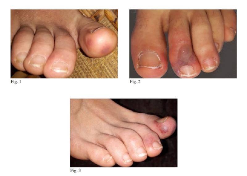 ▲義大利醫師臨床案例發現腳趾皮膚病變症狀。（圖／翻攝國際足科醫師聯盟網站）