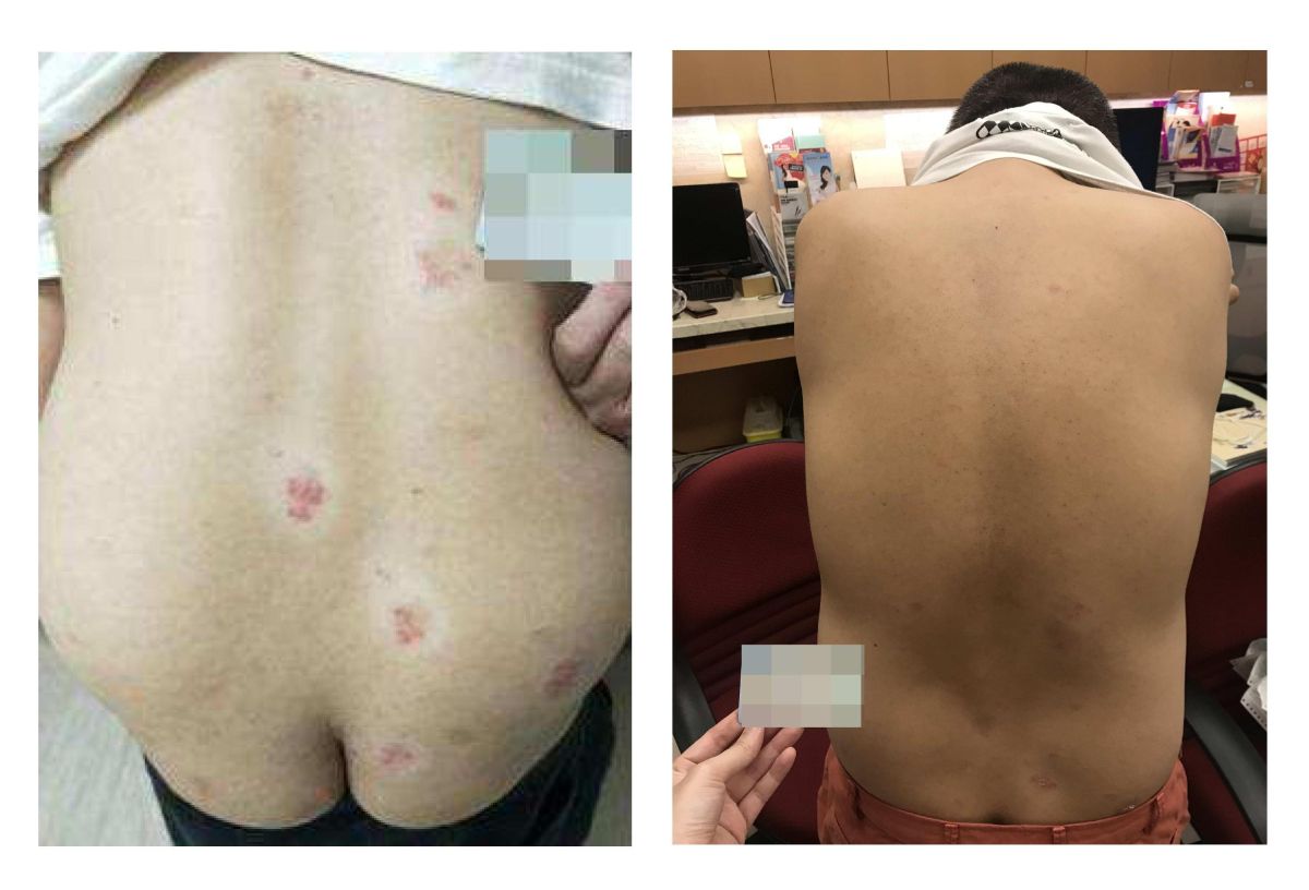 ▲背部亦患有乾癬，治療前(左圖)與治療後(右圖)的對照，症狀已明顯改善。 (圖／醫院提供2020.4.27)