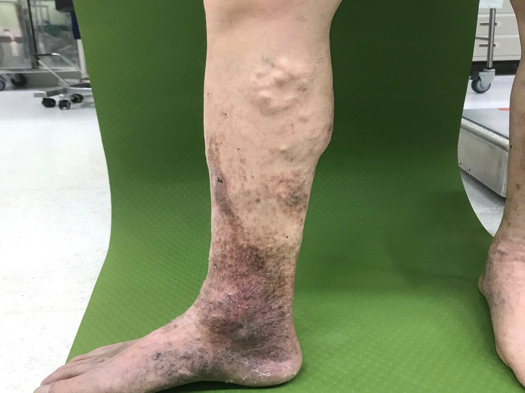 ▲醫師提醒，久站久坐小心靜脈曲張找上門。（圖/醫院提供）