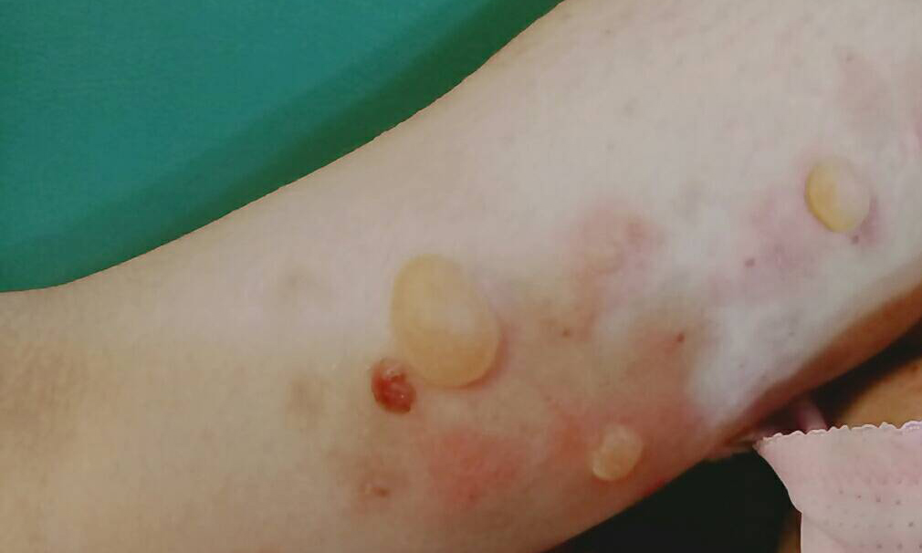 ▲類天皰瘡不易照顧，容易有傷口感染的問題。（圖/大林慈濟提供，2020.04.29）