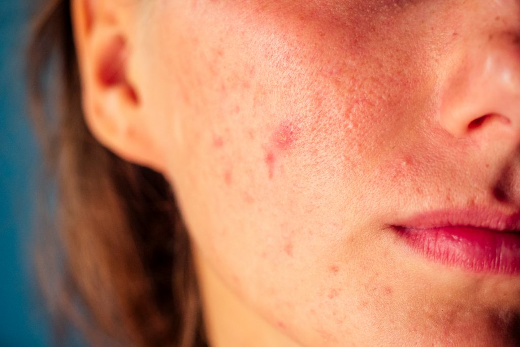 ▲戴口罩容易悶出痘痘。（圖／Shutterstock）