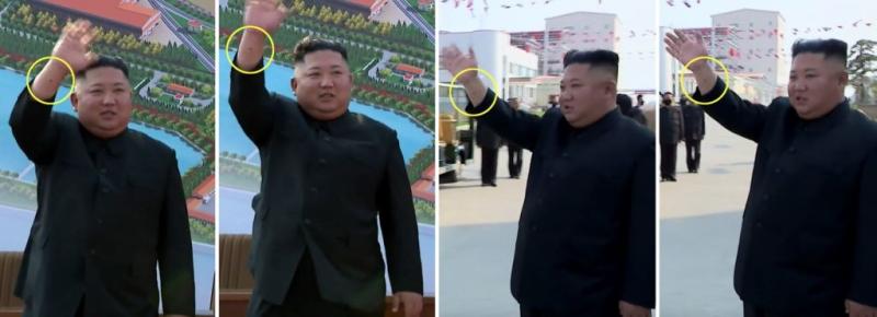 ▲金正恩手臂上疑似出現傷痕。(圖/翻攝自