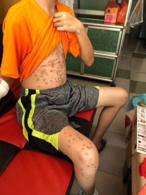 ▲被害少年他的胸前及雙腳共有超過100個暗色傷痕。（圖／NOWnews資料照）