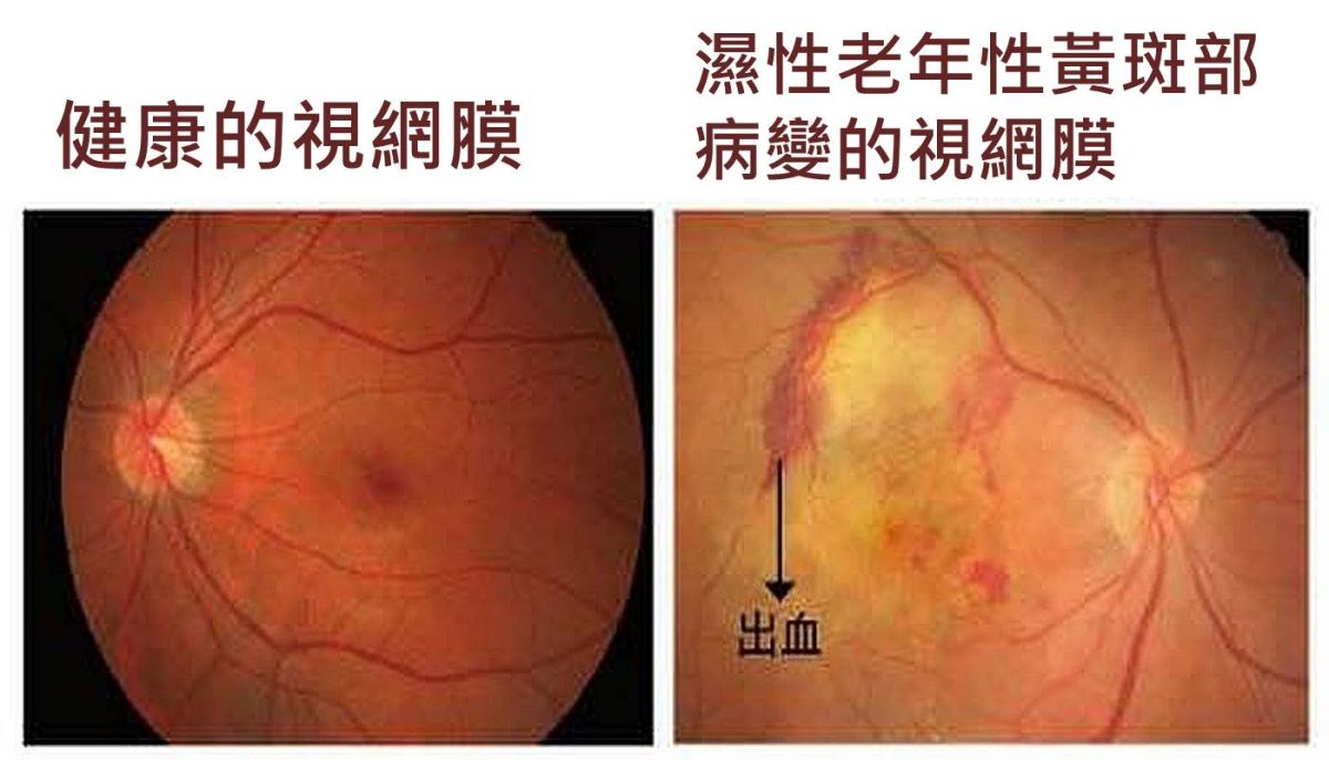 ▲老年視網膜黃斑部病變。（圖／台南安南醫院）