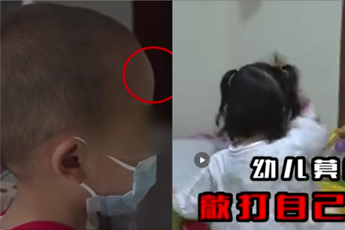 ▲長期攝取飲料當奶粉的孩童出現顱骨突出、敲打頭部等異狀。（合成圖／翻攝西瓜視頻）