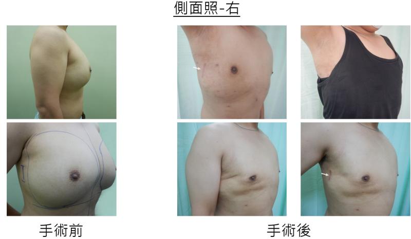 ▲彰基施以「3D內視鏡乳房手術」成功變回型男。(圖/記者陳雅芳翻攝,2020.05.15)