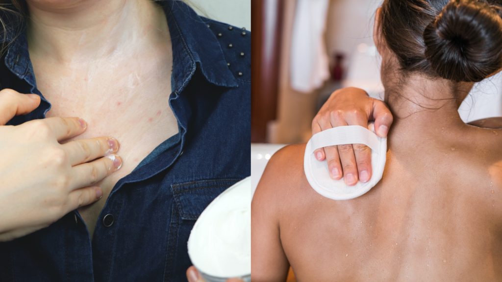 ▲背、胸、臀是痘痘好發高危區。（圖／Shutterstock）