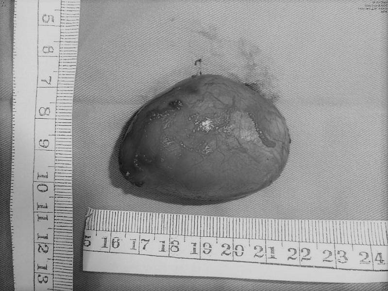 ▲以微創手術為國中女進行口腔手術,順利取出6公分大的囊腫。(圖/長庚醫院提供)