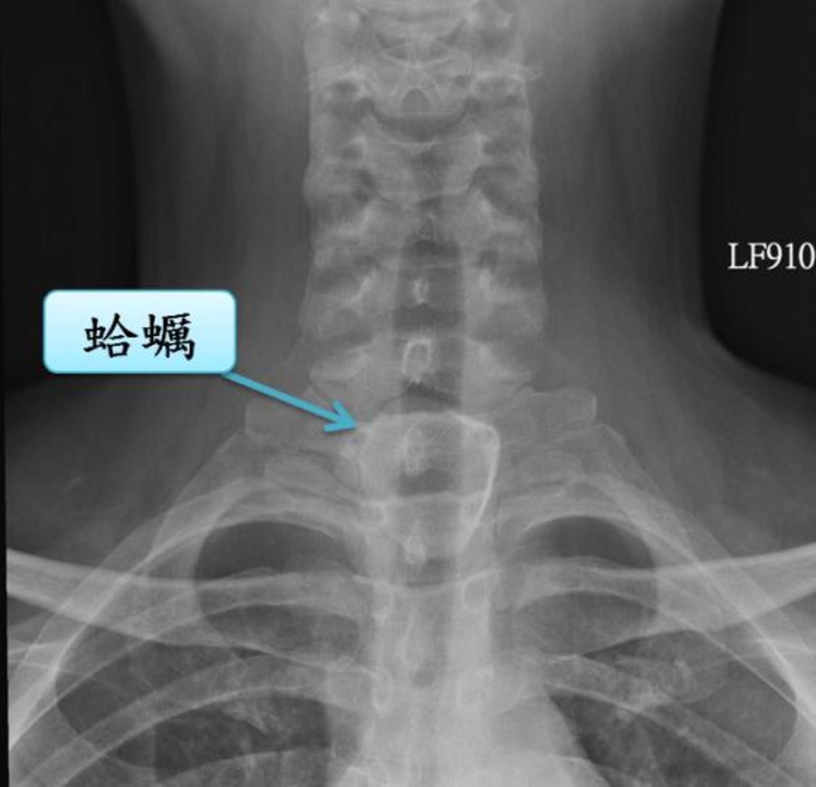 ▲男子遭蛤蜊卡住食道。（圖／安南醫院提供）