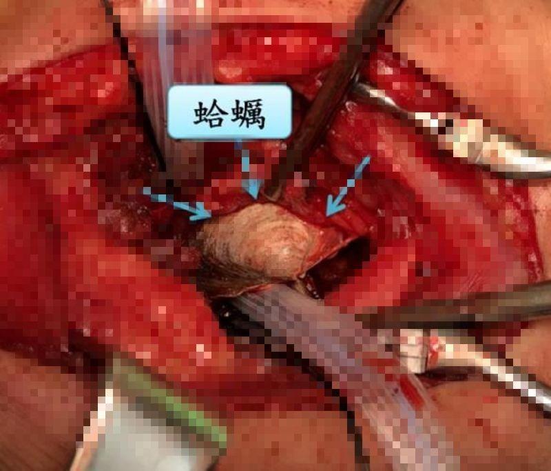 ▲蛤蠣殼已造成食道深度潰瘍及出血。(圖/安南醫院提供)