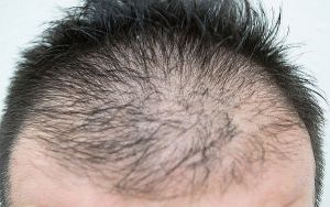 ▲美國布朗大學研究指出，觀察到新冠肺炎重症男性患者，禿頭比例高的情形。（示意圖，非本人／取自photoAC）