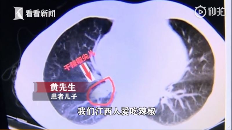 ▲黃姓男子因為嗆進辣椒塊,才會出現咳嗽、發熱症狀。(圖/翻攝看看新聞)