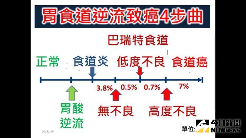 ▲大約有4成的胃食道逆流患者,若未及時處理錯過黃金治療期,就有可能變成癌症。(圖/記者陳雅芳攝,2020.06.15)