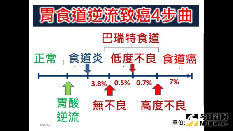 ▲大約有4成的胃食道逆流患者，若未及時處理錯過黃金治療期，就有可能變成癌症。（圖／記者陳雅芳攝，2020.06.15）