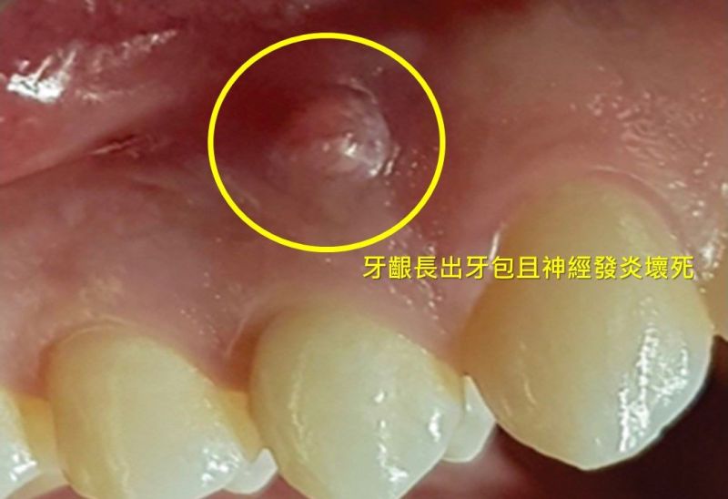 ▲牙齦長出牙包且神經發炎壞死。（圖／奇美醫學中心提供）