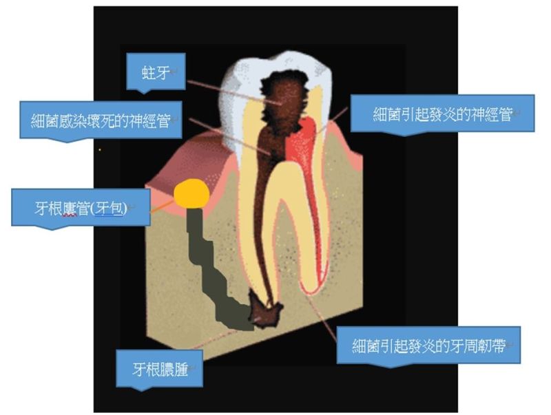 ▲牙齒根管中不只有神經而已,還有血管及其他組織。(圖/奇美醫學中心提供)