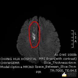 ▲天氣熱體內水分又在高溫下揮發迅速,血液變濃稠且流動緩慢,造成血壓降低形成腦部血液灌流不足,容易引發腦中風。(圖/記者陳雅芳翻攝,2020.06.26)
