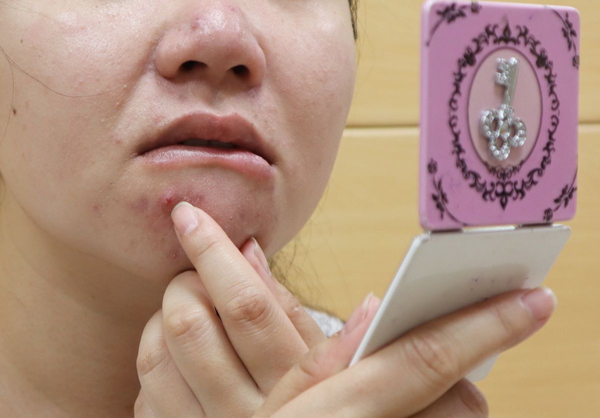 ▲中醫科賴博政醫師問診檢查告知李小姐，這些在臉上及胸口的痘痘是痤瘡，發炎性痤瘡一般長在面部T字部位、雙頰、下巴、胸口和背部。（圖/衛福部臺北醫院提供）