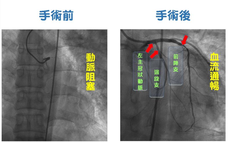 ▲病患手術前左主冠狀動脈完全阻塞，打通前降支慢性完全阻塞、迴旋支和中間支血管，再放置主動脈氣球幫浦控制心臟衰竭，手術順利。（圖/記者金祐妤翻攝,109.7.1）
