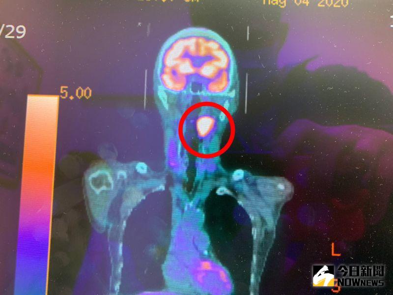▲正子攝影掃描，紅圈處可看出口咽癌位置。（圖／記者陳雅芳翻攝，2020.07.04）