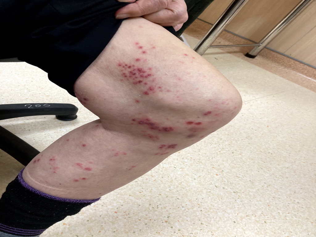 ▲台灣糖尿病患者超過250萬人，其中第2型糖尿病患者發生皮蛇的機率是一般人2倍，應多注意。（圖／NOWnews資料照）