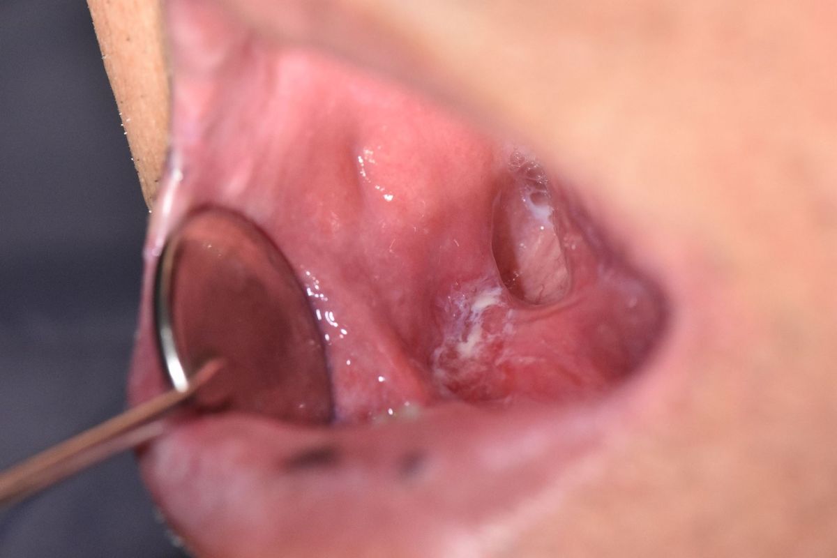 ▲右側後臼齒區口腔癌，白斑清楚可見。（圖／安南醫院提供）