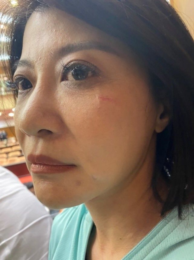 ▲除了被咬之外,林楚茵臉部也有擦傷。