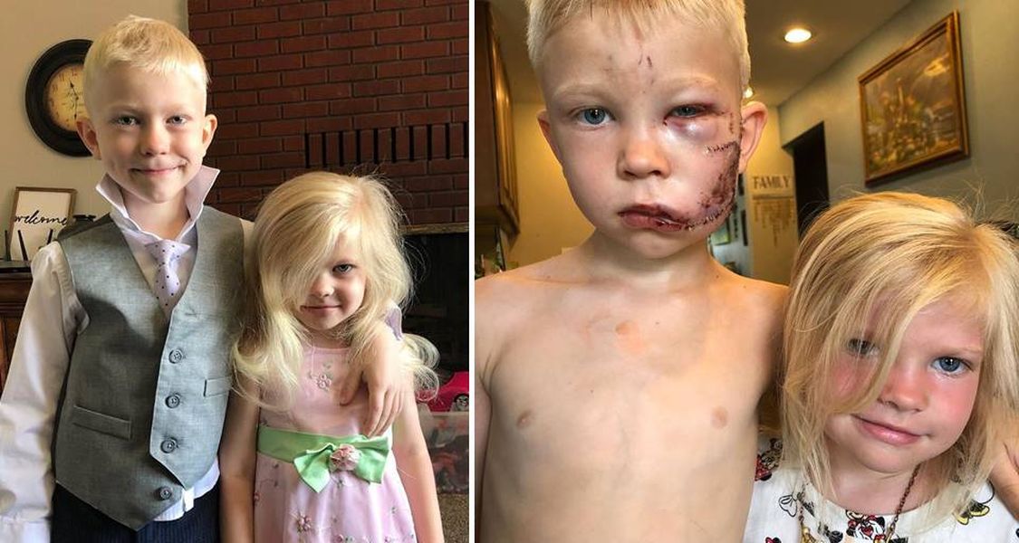 ▲布里吉渥克（左）為保護妹妹，被狗咬到毀容（圖／翻攝nicolenoelwalker IG）