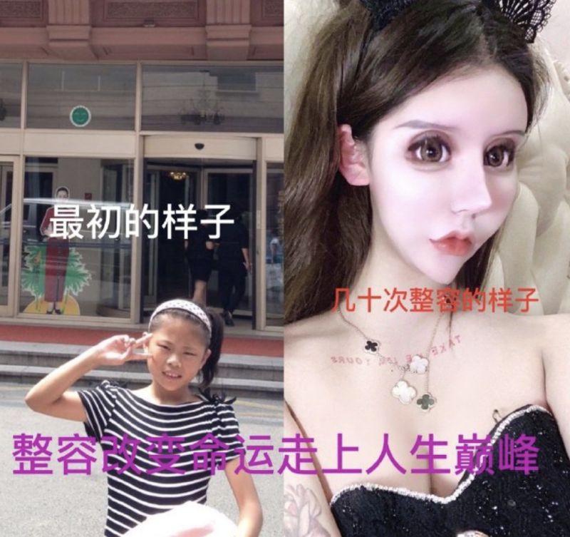 ▲▲中國網紅「小z娜娜」大方分享整形前後對比照(圖|翻攝自微博/小z娜娜Nana)
