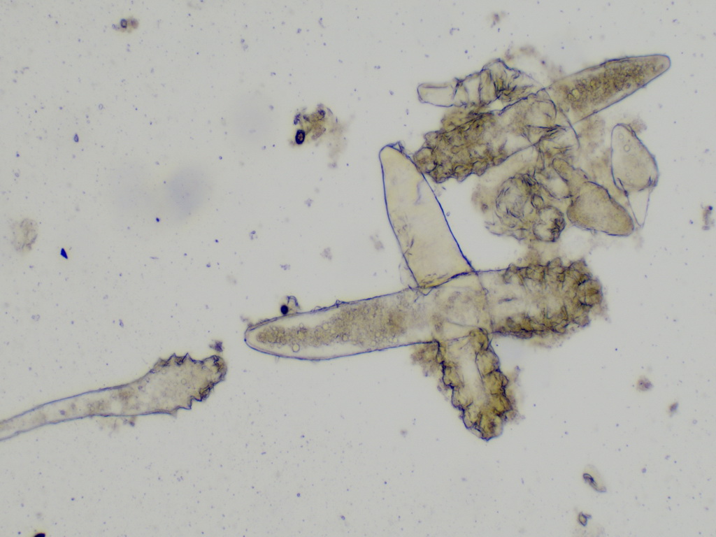 ▲眼睛取出蠕形蟎。(圖／醫院提供2020.8.4)