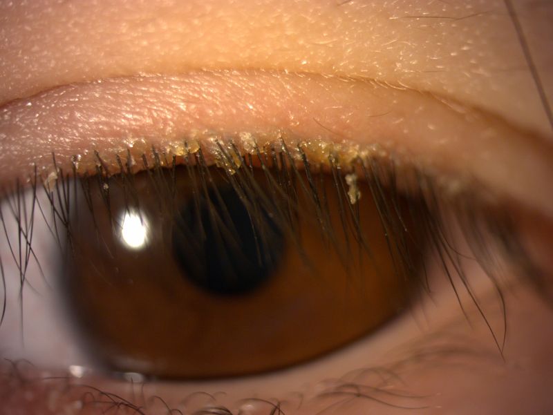 ▲婦人眼瞼邊緣紅腫，且有明顯皮屑堆積，透過顯微鏡確診為蠕形蟎蟲引起的眼瞼炎。（圖／亞洲大學附屬醫院提供）