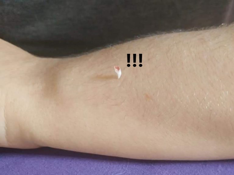 土耳其一名網友分享一組關於手臂上被釘牙齒的照片引起網友熱議（圖／翻攝自FB@CENİN）
