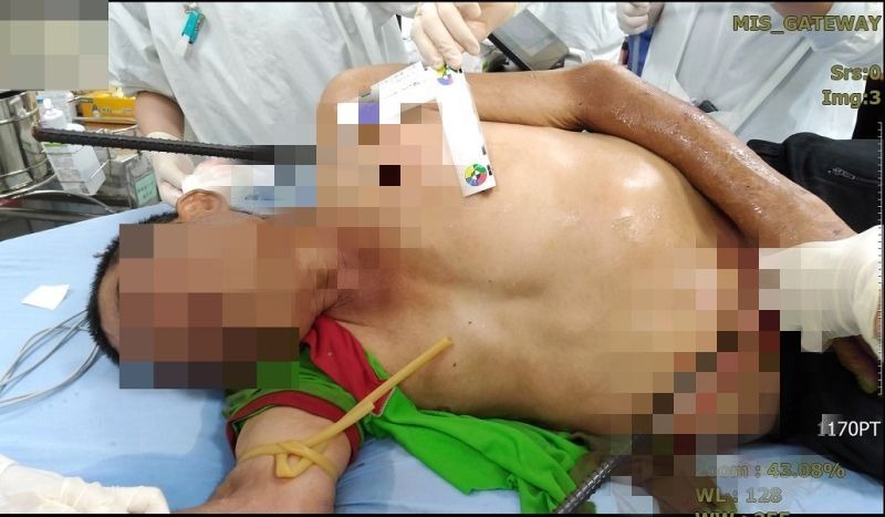 ▲嘉義縣建築工在工地工作，不慎從高處摔落，遭2條約80公分長的鋼筋鐵條直接貫穿胸腔與臀部。(圖／慈濟醫院提供）