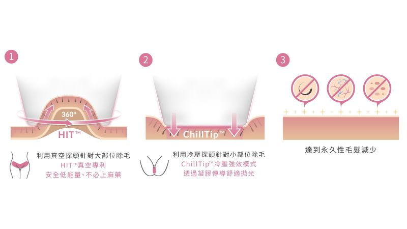 ▲新式「真空除毛」治療原理圖（圖／資料照片）