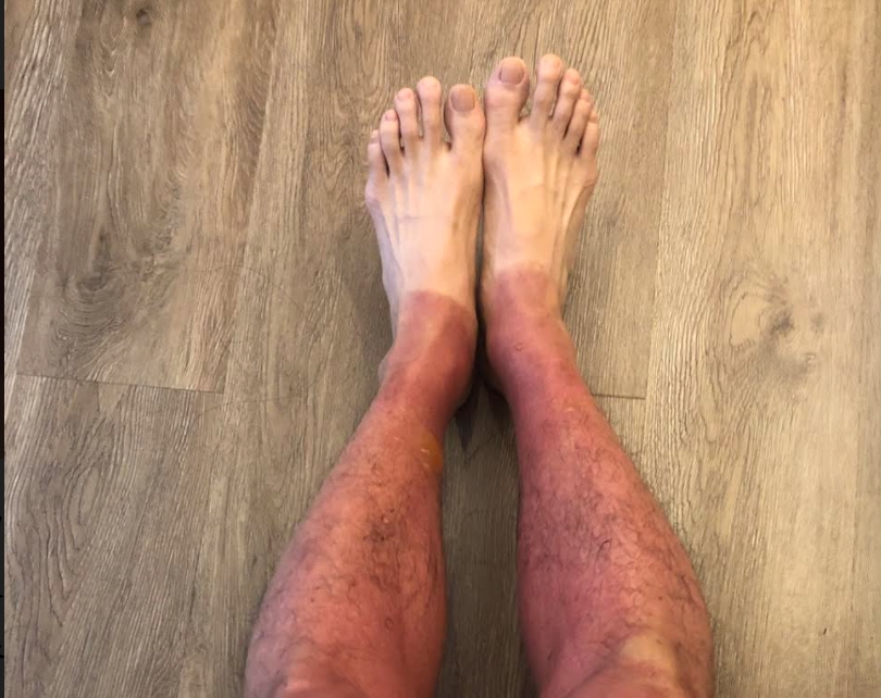 ▲一名男子去參與獨木舟戲水，因為沒有防曬皮膚嚴重曬傷。（圖／書田診所提供）