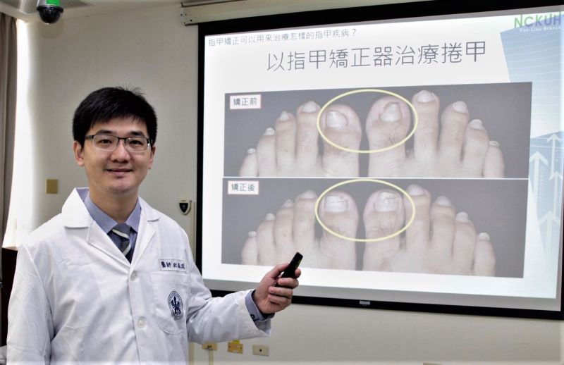 ▲杜威廷醫師說明指甲矯正已取代部分捲甲和嵌甲病人的手術治療。(圖/記者蘇榮泉攝,2020.10.13)