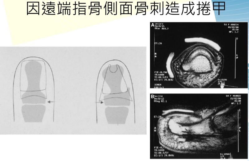 ▲因遠端指骨側面骨刺（右圖）造成捲甲。（圖／記者蘇榮泉翻攝，2020.10.13）