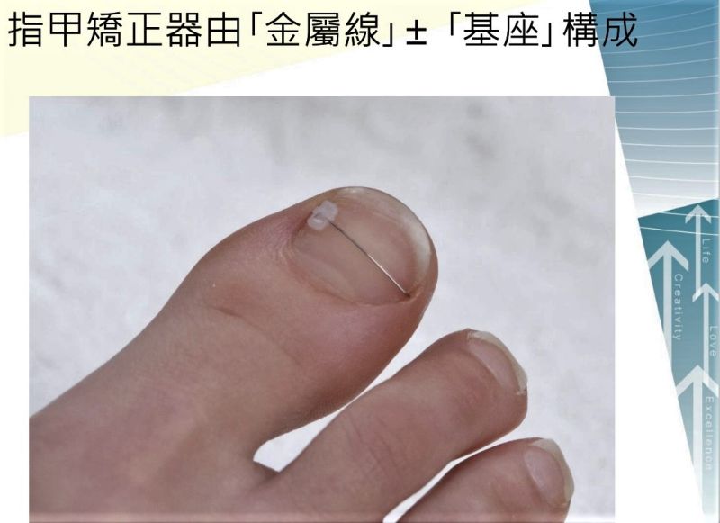 ▲以指甲矯正器治療的病人,一年後復發率約為10%。(圖/記者蘇榮泉翻攝,2020.10.13)