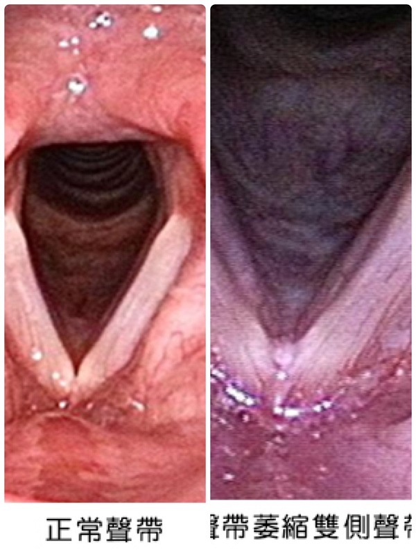 ▲左為正常聲帶，右為雙側聲帶萎縮及組織凹陷。(圖／記者陳惲朋依長庚醫院提供圖片併編)