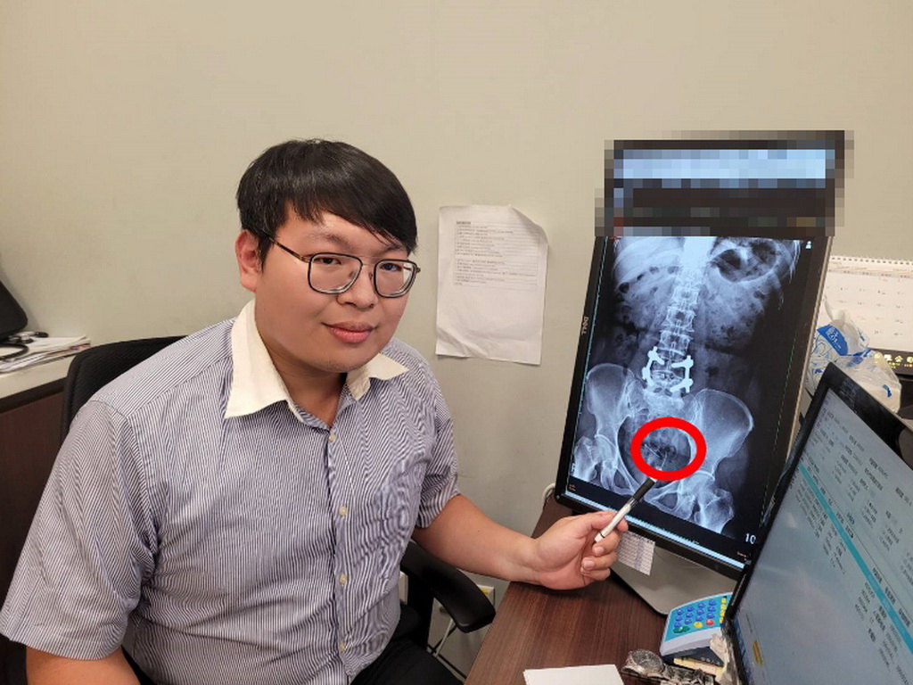 ▲子宮避孕器穿過膀胱在內側長出一顆結石，造成反覆泌尿道感染及發燒。(圖／醫院提供2020.10.31)
